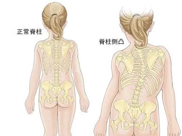 青少年睡姿不對(duì)，真能把脊柱睡“彎”嗎,？