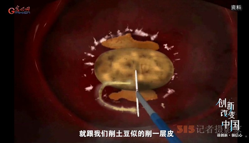 宮頸癌消滅戰(zhàn):如何減少“梅艷芳式悲劇”,? 宮頸癌消滅戰(zhàn):如何減少“梅艷芳式悲劇”?